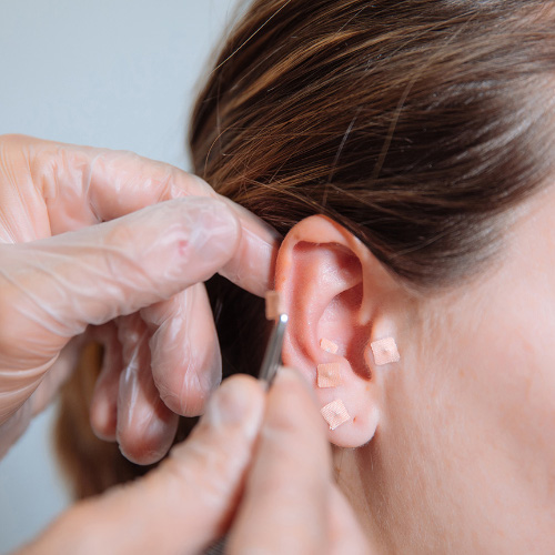 imagens_auriculoterapia